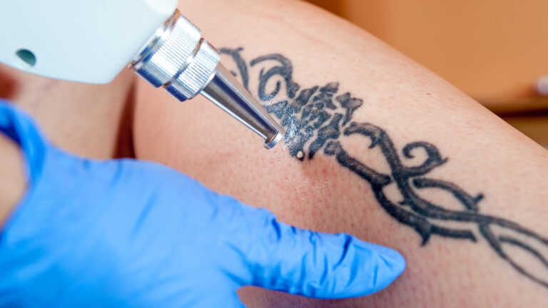 Tattoo Removal